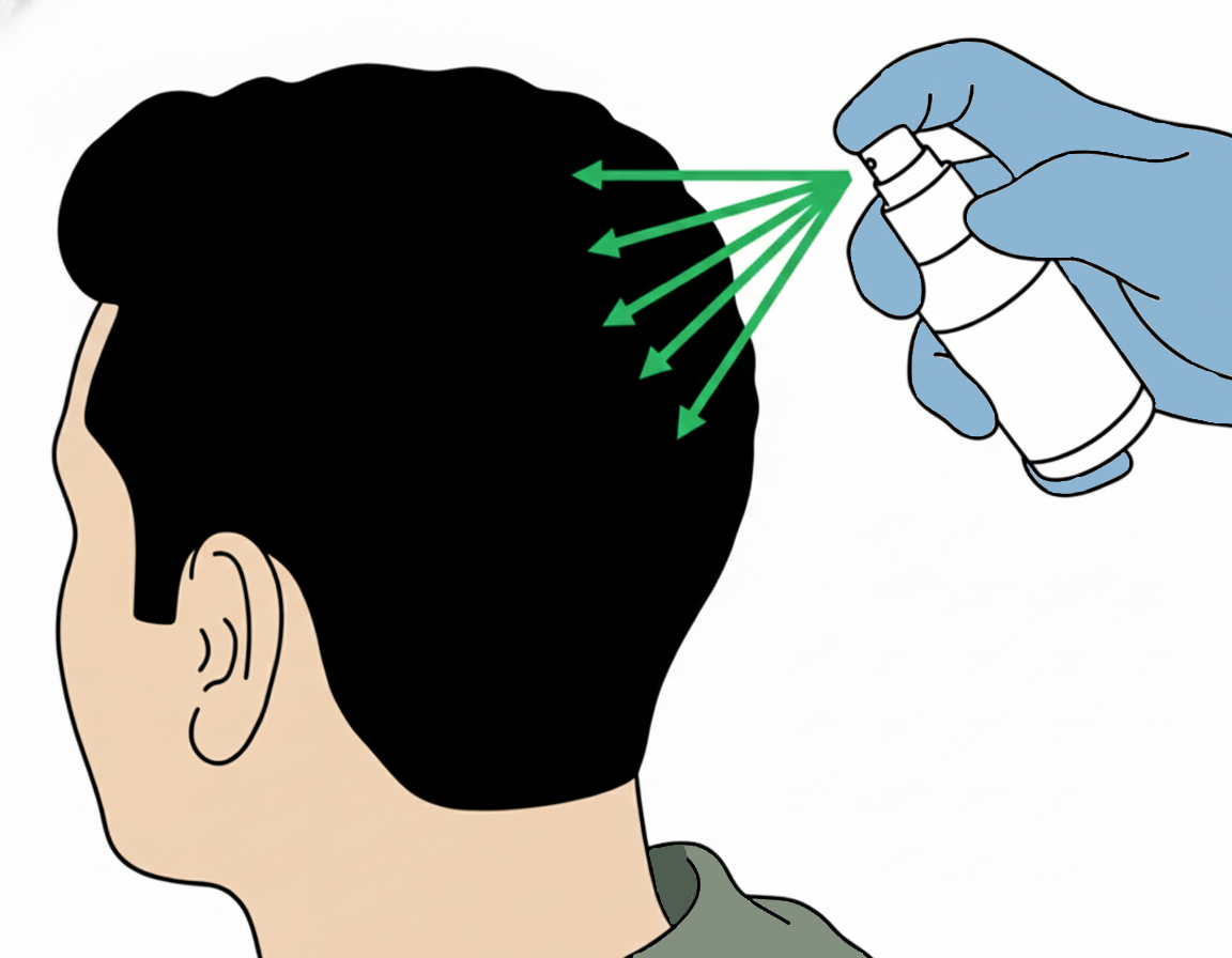 Applying preparation solution to the scalp at the back of the head